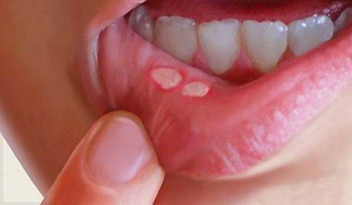 Bệnh nhiệt miệng – Bệnh của mùa nắng nóng 0