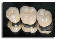 Răng sứ có độ bền như thế nào? 1