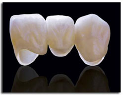 Răng sứ có độ bền như thế nào? 0