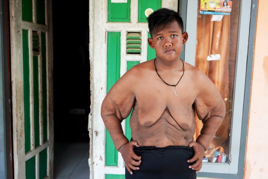 Cậu bé 'mập nhất thế giới' chuẩn bị phẫu thuật cắt bỏ da thừa sau khi giảm hơn 100 kg 1