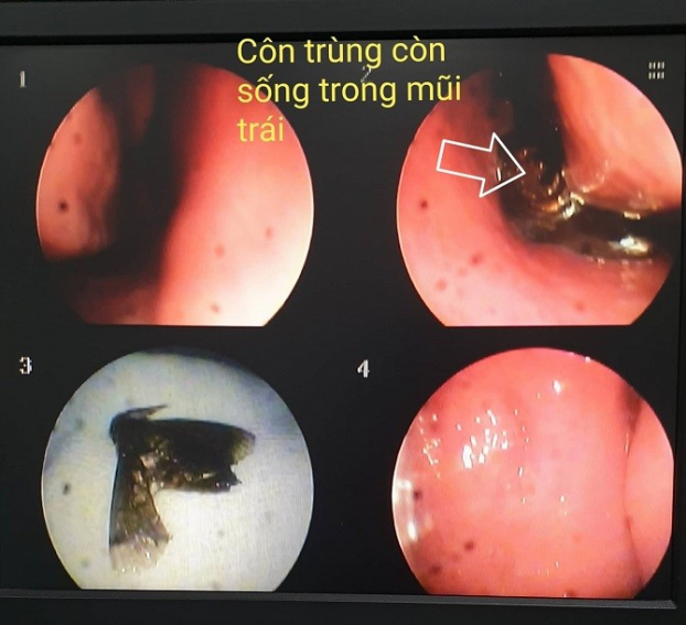   Hình ảnh côn trùng còn sống trong mũi bệnh nhân  