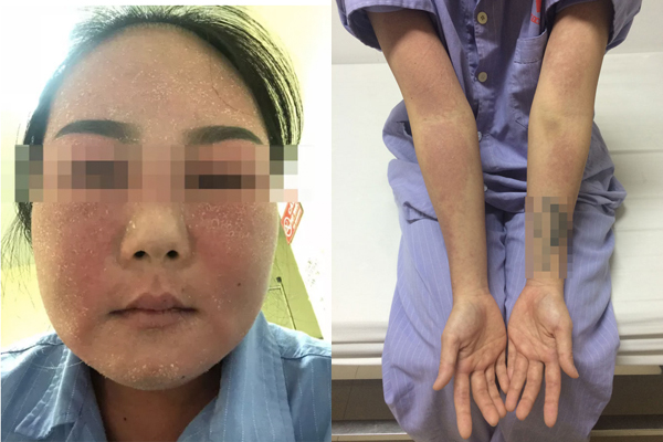 Bôi kem trắng da, cô gái Quảng Ninh bị nhiễm trùng toàn thân do dị ứng mỹ phẩm 0