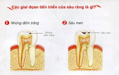 Vì sao đánh răng hàng ngày, răng vẫn bị sâu? 2