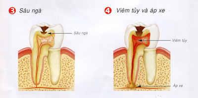 Vì sao đánh răng hàng ngày, răng vẫn bị sâu? 3