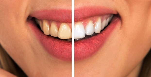 8 mẹo chữa sâu răng, làm liền lỗ sâu răng tự nhiên cực đơn giản, ai cũng có thể làm được 4