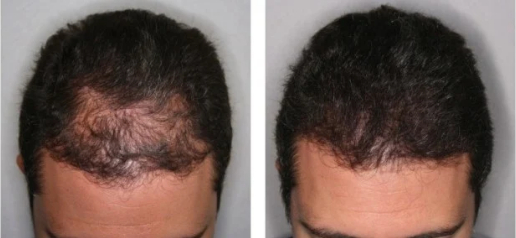 Nghiên cứu mới: Ăn kim chi có thể giúp tóc mọc nhanh, chữa hói đầu? 3
