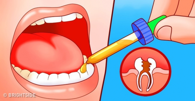 7 cách chữa đau răng sâu tại nhà nhanh nhất không cần thuốc 2