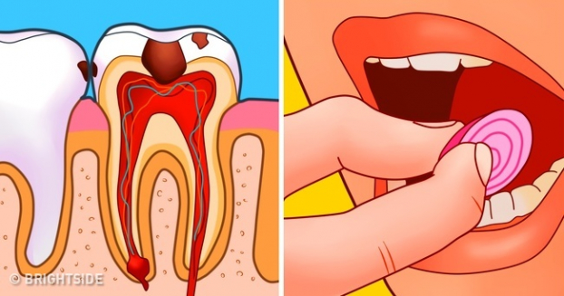 7 cách chữa đau răng sâu tại nhà nhanh nhất không cần thuốc 7