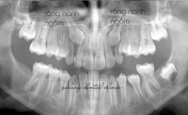 Răng nanh mọc ngầm 3