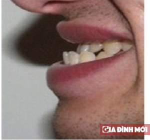 Răng móm - Khớp cắn ngược: điều trị thế nào cho đẹp? 2