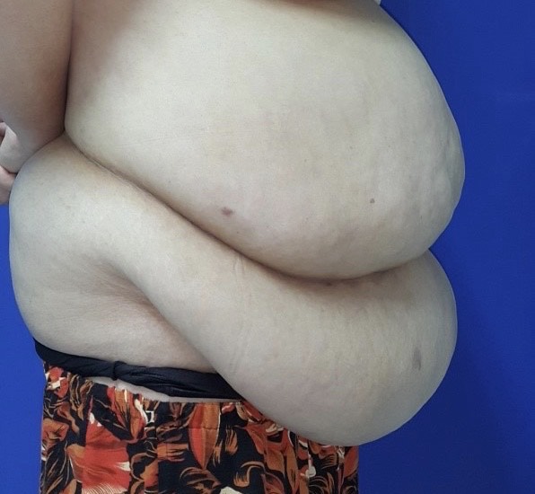   Hình ảnh bệnh nhân trước khi phẫu thuật tạo hình thành bụng, cắt mỡ thừa.  