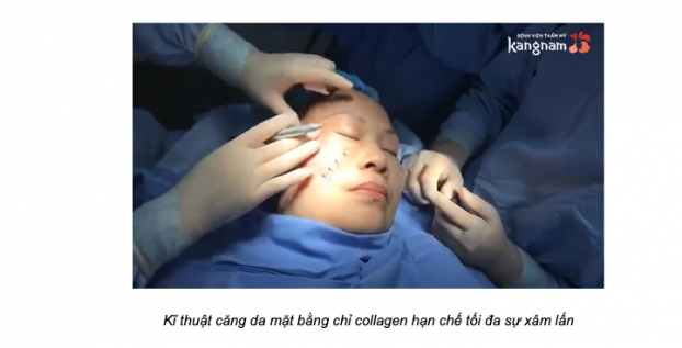 Thẩm mỹ viện Kangnam: Dịch vụ căng da mặt tiến hành thế nào? 3