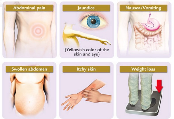   Một số dấu hiệu cảnh báo ung thư gan như: Đau bụng, vàng da, buồn nôn/nôn, sưng bụng, ngứa, sút cân  
