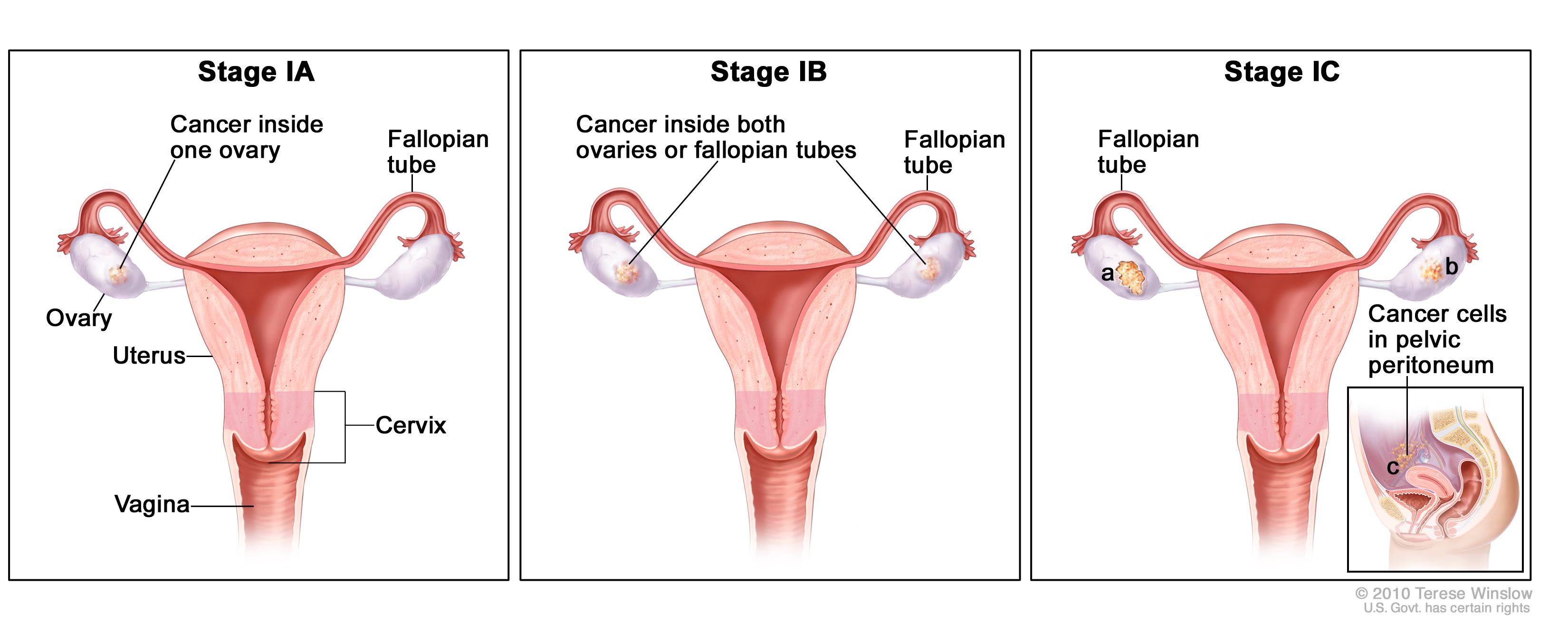   Giai đoạn đầu của ung thư buồng trứng  
