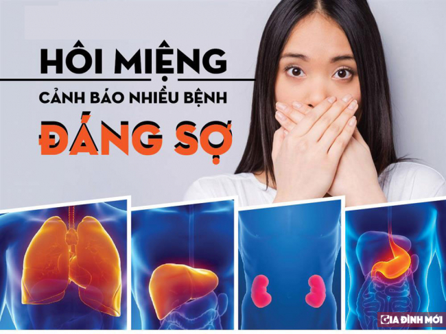 Hôi miệng: Nguyên nhân, cách điều trị nhanh và hiệu quả nhất 2