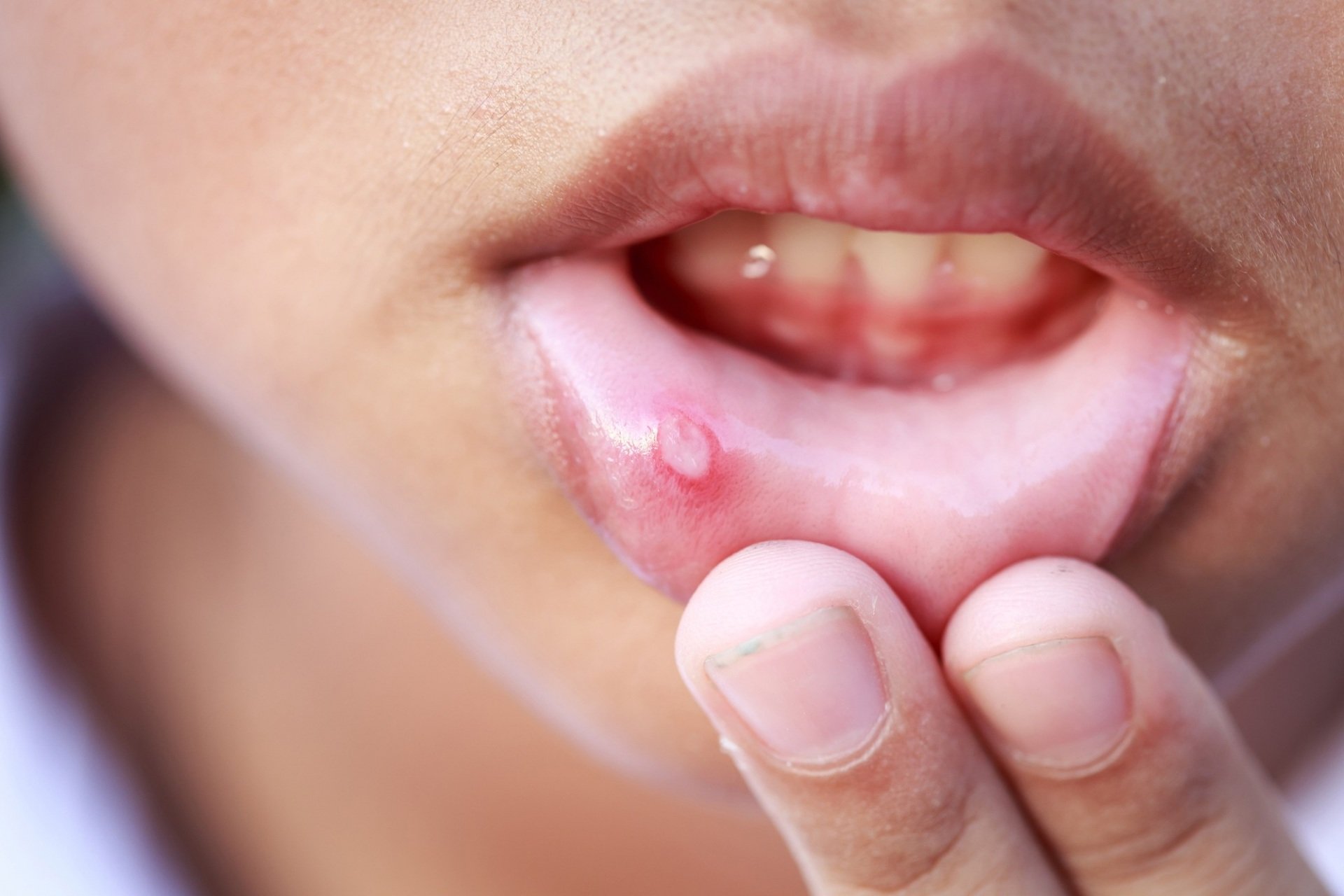   Đau loét miệng kéo dài có thể là triệu chứng ung thư miệng  