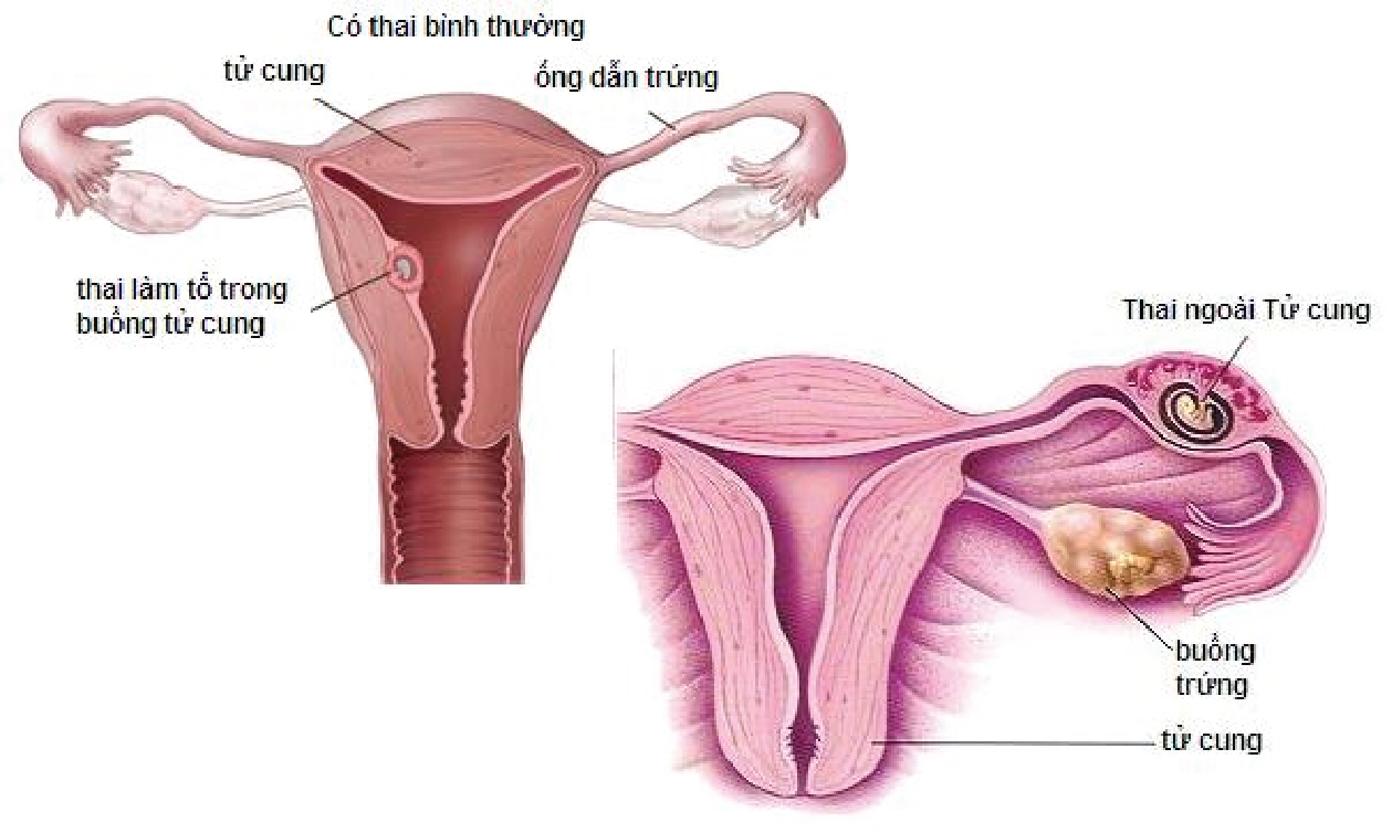  5 cách giảm nguy cơ ung thư buồng trứng phụ nữ nào cũng nên áp dụng  