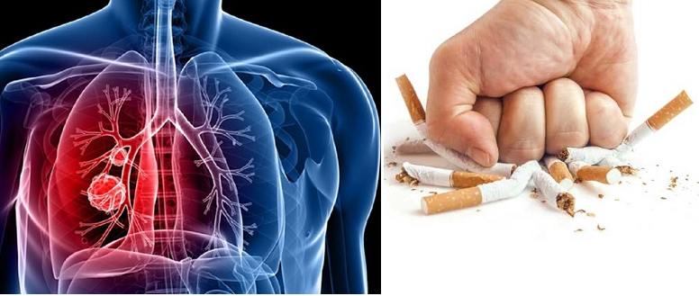   Ung thư phổi có phòng tránh được không?  