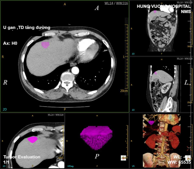   Hình ảnh khối u tại gan của nam bệnh nhân (phần màu tím)  