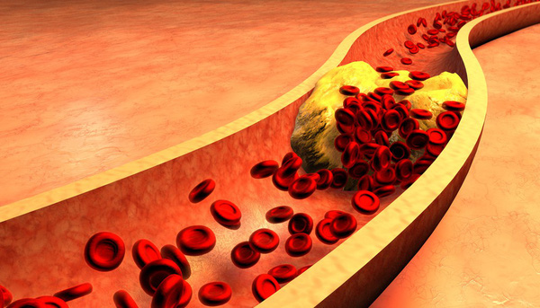   Điều trị cholesterol xấu giúp ngăn ngừa bệnh tim mạch về sau  