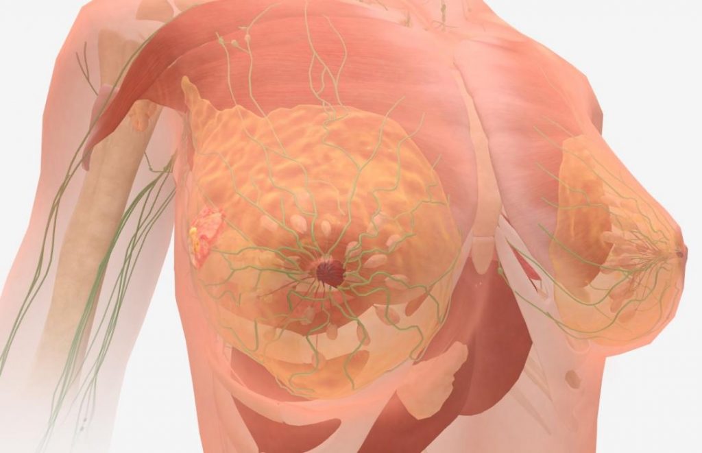   Bệnh ung thư vú di căn: 14 điều bệnh nhân và người nhà nên biết  