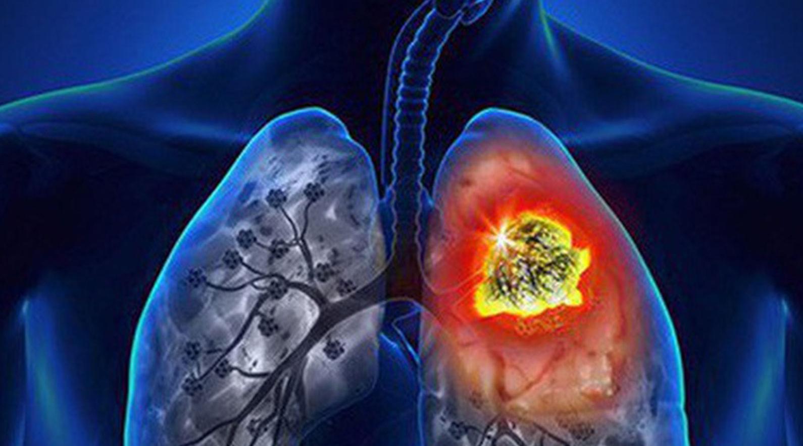   Những thói quen bạn nên tránh xa nếu không muốn bị viêm phổi, ung thư phổi  