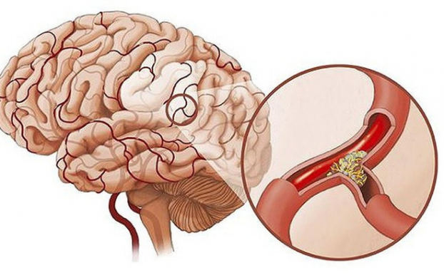 Bác sĩ Việt Đức chỉ ra những dấu hiệu cần biết về căn bệnh nhồi máu não 0