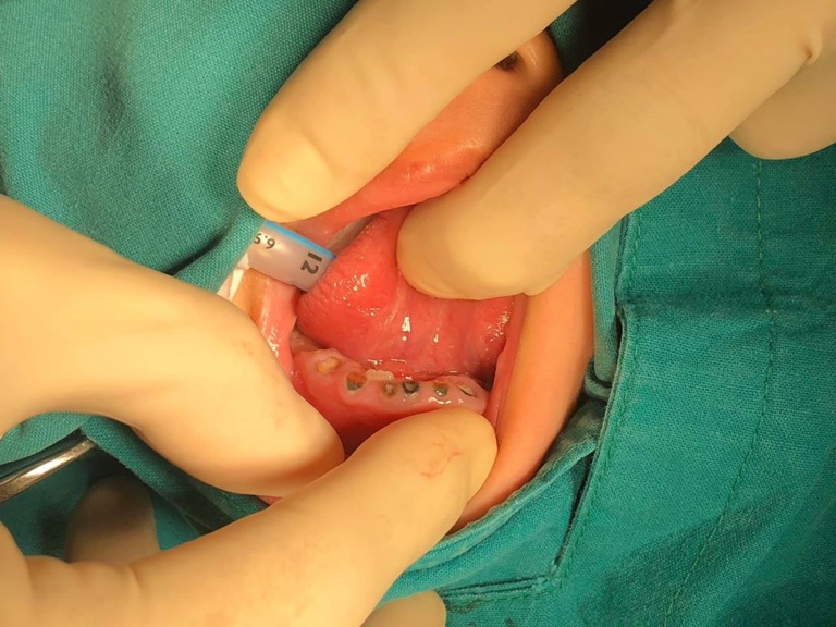Bé trai 4 tuổi bị nhổ gần hết hàm răng vì không giữ vệ sinh răng miệng 1