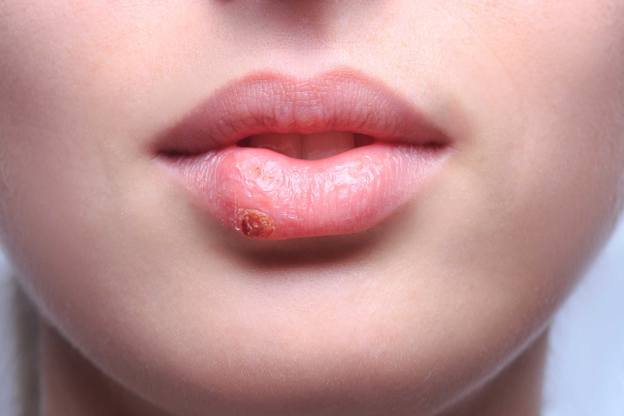   Lở môi do do vi rút Herpes Simplex gây ra  