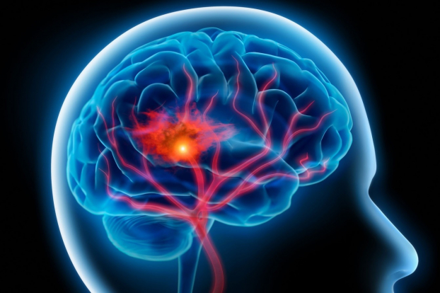   Thay đổi ngay 6 yếu tố nguy cơ để ngăn ngừa đột quỵ não hiệu quả  