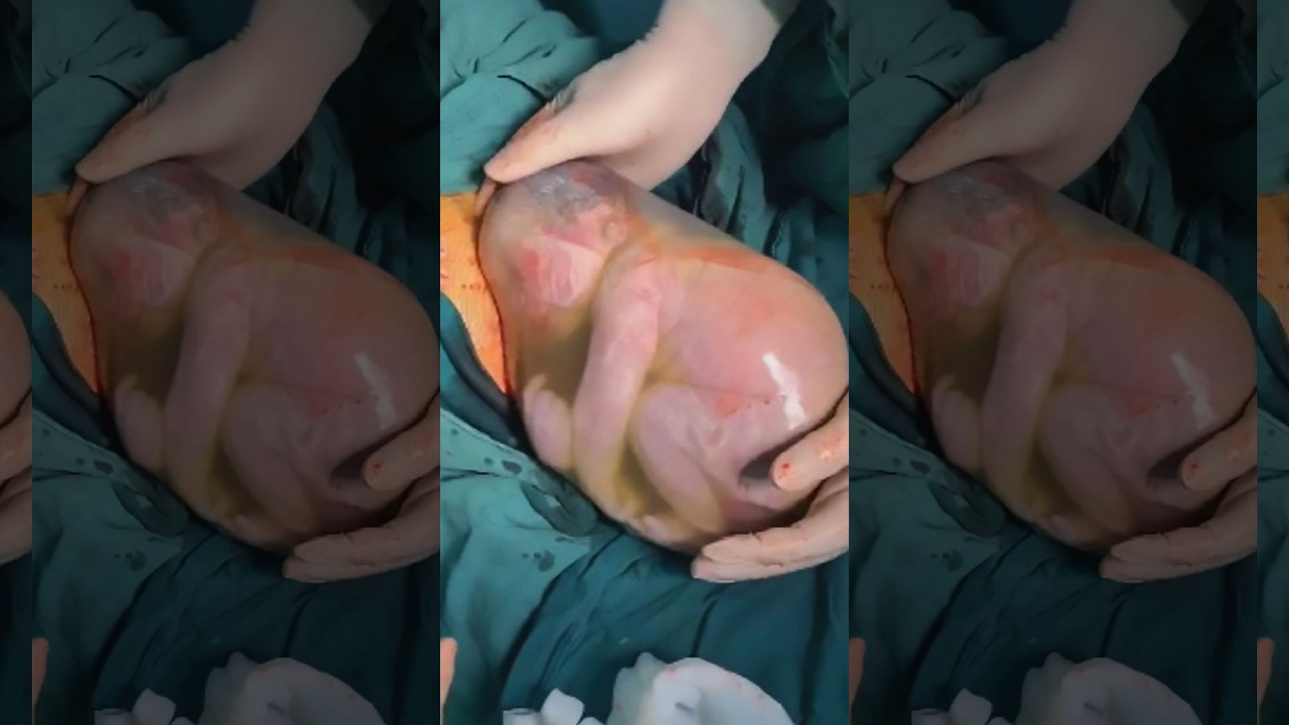   Một em bé người Trung Quốc sinh ra vẫn còn nguyên bọc ối (Ảnh Internet)  