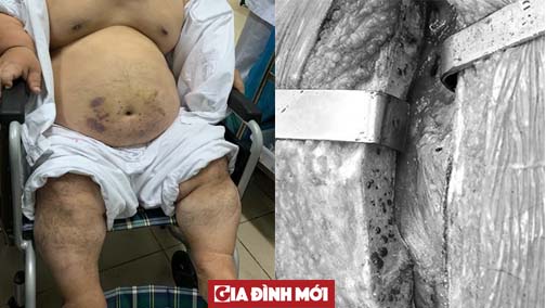   Bệnh viện Việt Đức phẫu thuật bắc cầu động mạch vành thành công cho bệnh nhân.  