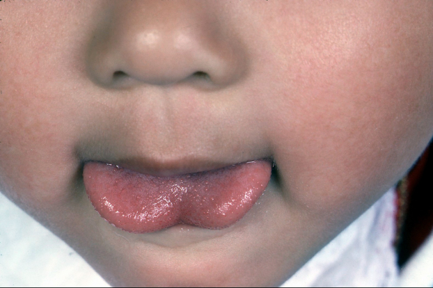   Thói quen đẩy lưỡi là thói quen xấu ảnh hưởng đến răng miệng của trẻ  