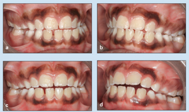   Khi mắc phải những thói quen xấu về răng miệng sẽ làm răng bị hô, lệch khớp cắn, ảnh hưởng xương hàm  