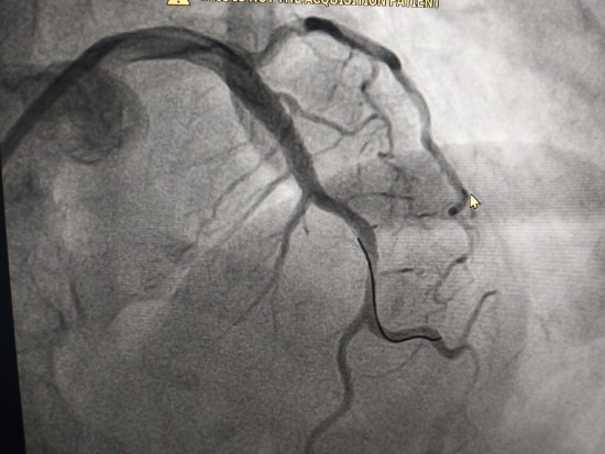   Hình ảnh mạch vành của một bệnh nhân sau can thiệp  