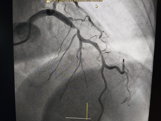   Hình ảnh mạch vành của một bệnh nhân trước can thiệp  