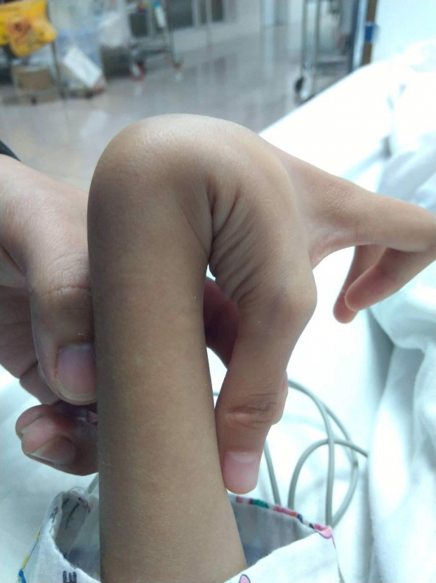   Hình ảnh khớp tay của cháu có thể uốn được đến 180 độ - một biểu hiện của Hội chứng Ehlers-Danlos  