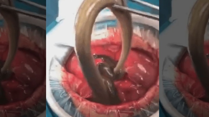   Tin tức y tế thế giới 17/1: 1 người đàn ông Trung Quốc phải cấp cứu vì chữa táo bón bằng cách nuốt lươn sống  