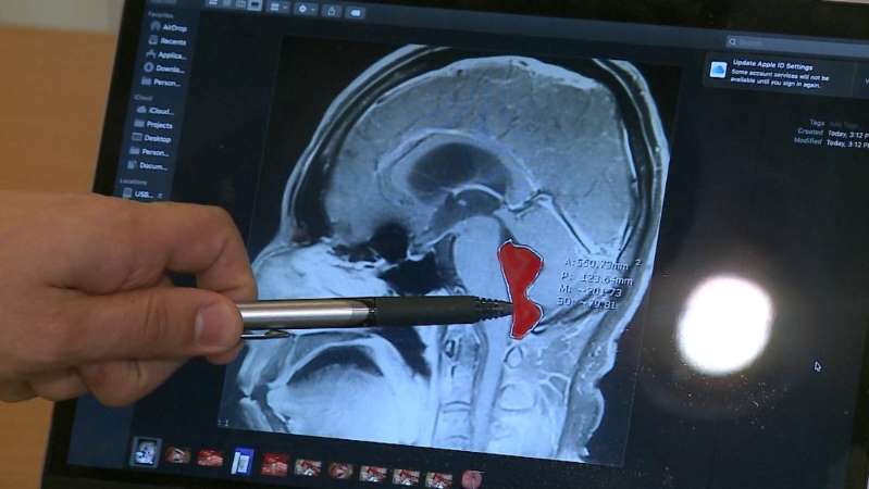   Người đàn ông ở Mỹ đau đầu nhiều năm hóa ra ra sán làm tổ trong não  