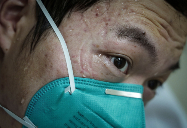 Những vết hằn trên mặt các nhân viên y tế tuyến đầu chống dịch COVID-19 0