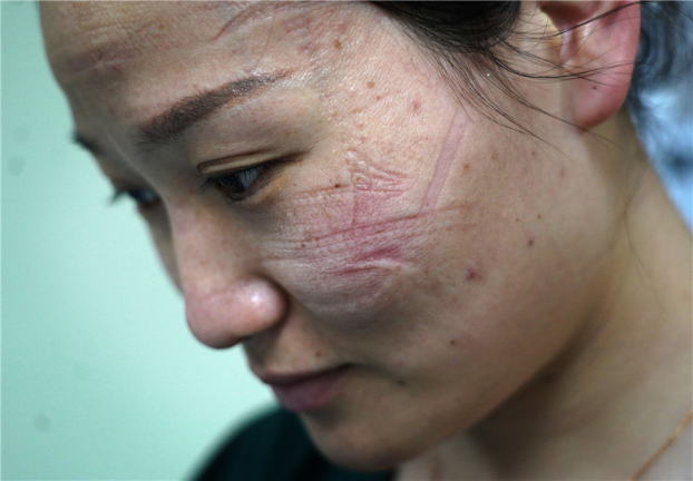 Những vết hằn trên mặt các nhân viên y tế tuyến đầu chống dịch COVID-19 5