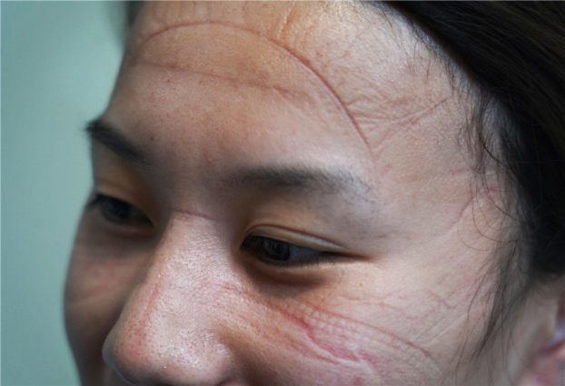 Những vết hằn trên mặt các nhân viên y tế tuyến đầu chống dịch COVID-19 6