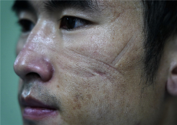 Những vết hằn trên mặt các nhân viên y tế tuyến đầu chống dịch COVID-19 3