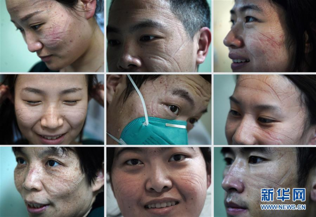 Những vết hằn trên mặt các nhân viên y tế tuyến đầu chống dịch COVID-19 9