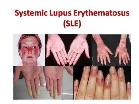   Biểu hiện của lupus ban đỏ thể hiện ở nhiều cơ quan  
