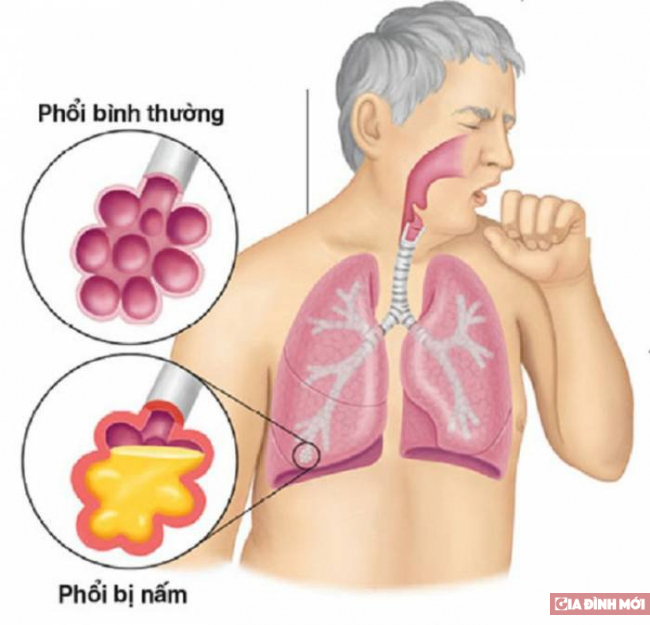   BV Phổi Trung ương sắp tổ chức Hội thảo Khoa học về bệnh phổi do nấm Aspergillus  