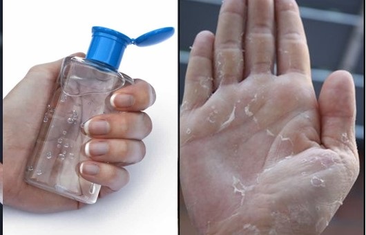   Sử dụng các sản phẩm rửa tay khô, sát khuẩn không đảm bảo chất lượng có thể ảnh dẫn tới bị viêm da tiếp xúc dị ứng, đỏ mẩn, bong tróc, ngứa... Ảnh minh họa  
