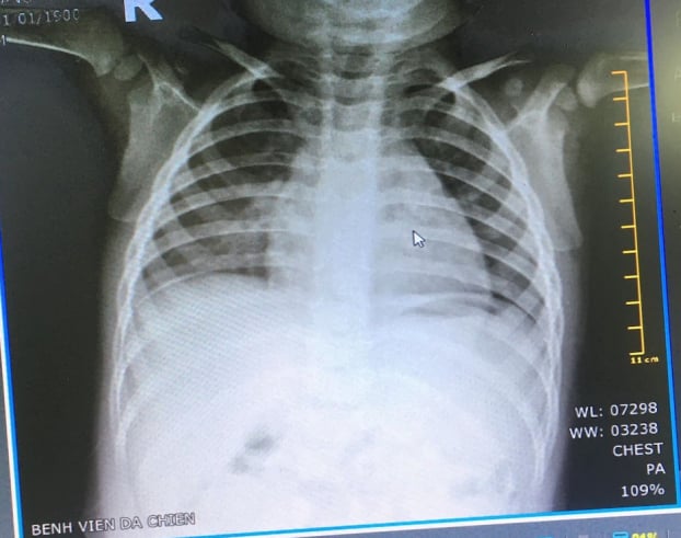   Hình ảnh X quang phổi được chụp tại BV dã chiến và được kết nối từ xa với BS chuyên khoa X quang để hội chẩn kết quả  