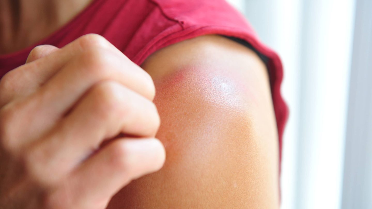   không chú ý bảo vệ da dưới ánh nắng cũng là sai lầm khiến da có thể bị khô, bong tróc và dễ bị mụn  