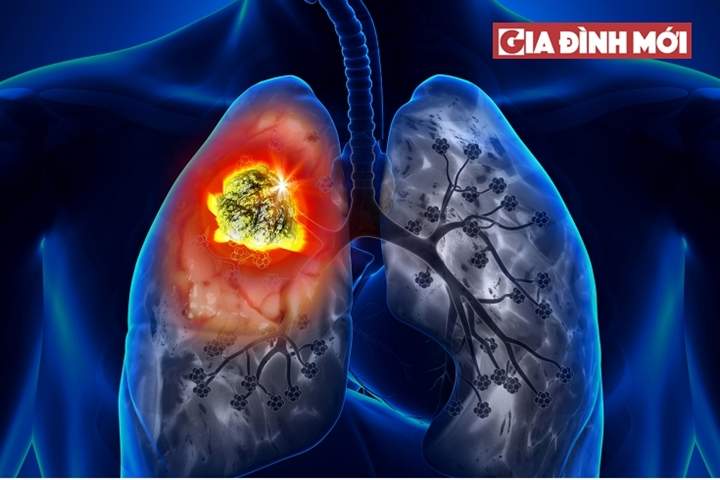   Ung thư phổi: Nguyên nhân, Triệu chứng, Cách điều trị  